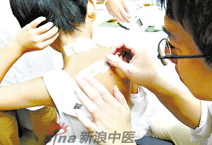 灸法的種類  你知道多少？